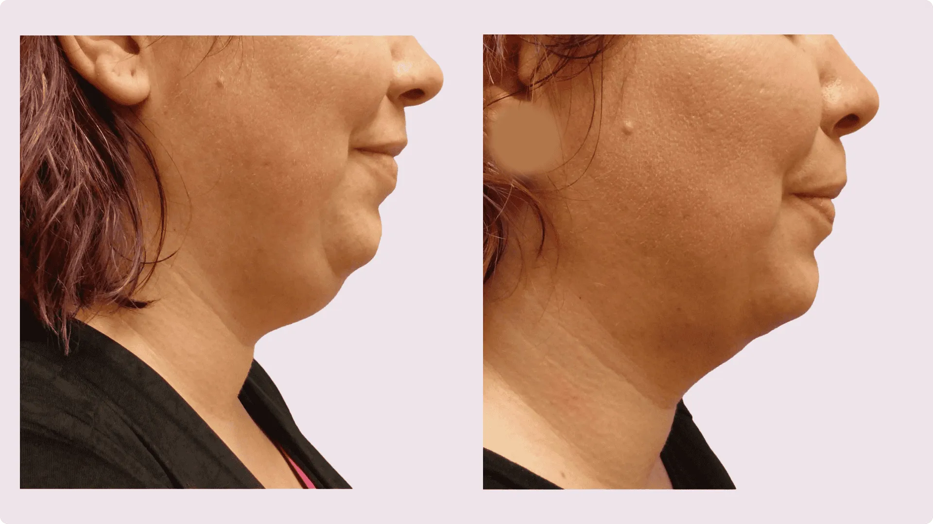 Kinn-Liposuktion – Vorher-Nachher-Foto 4