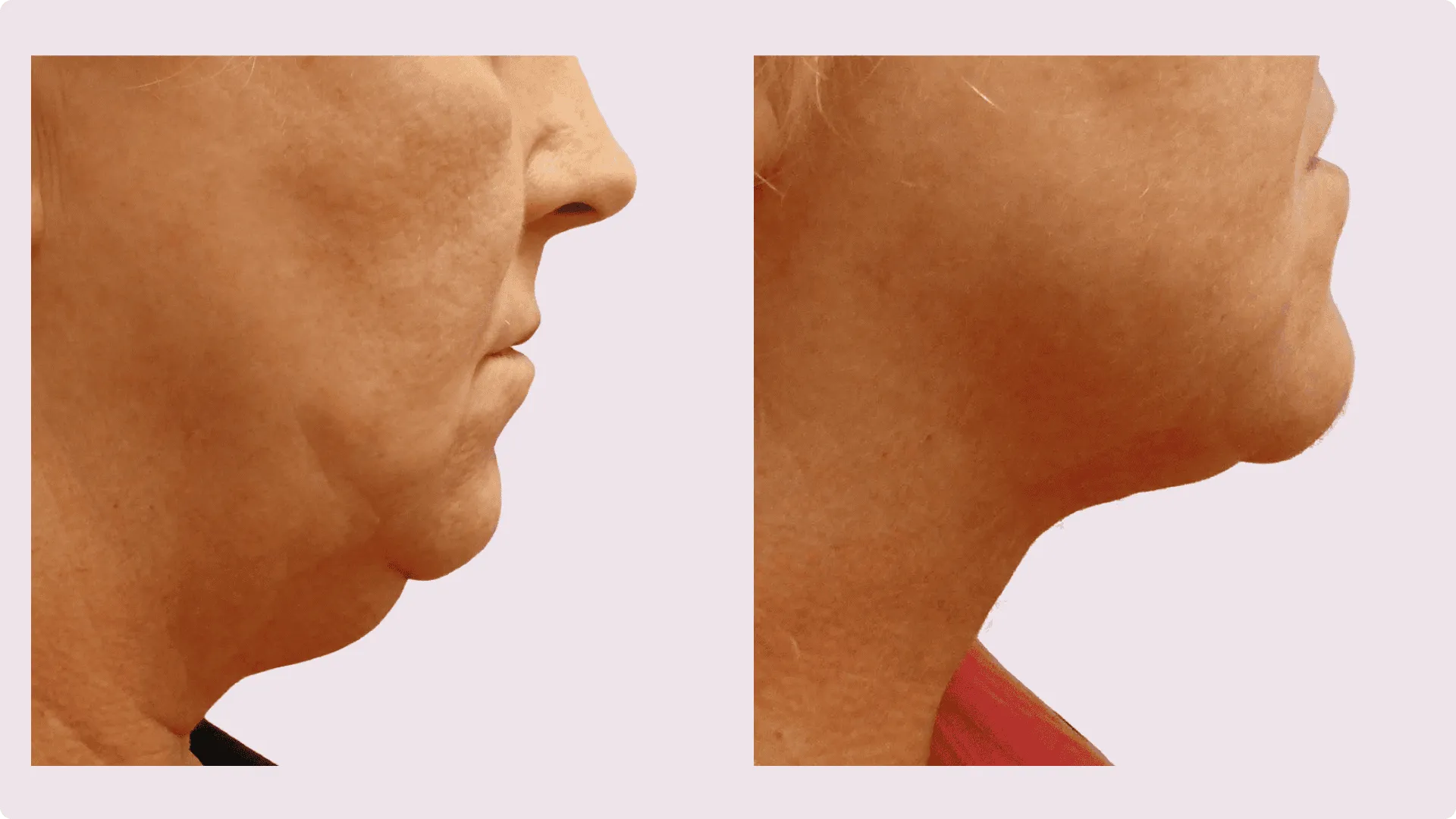 Kinn-Liposuktion – Vorher-Nachher-Foto 5