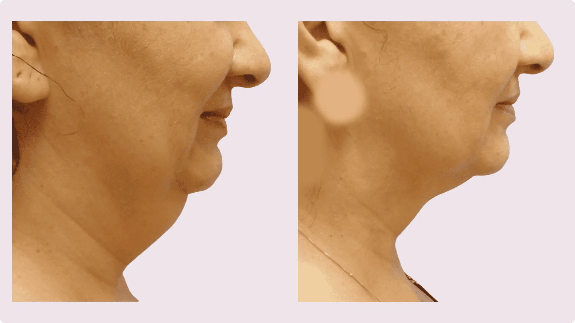 Chin Liposuction – before and after photo 5