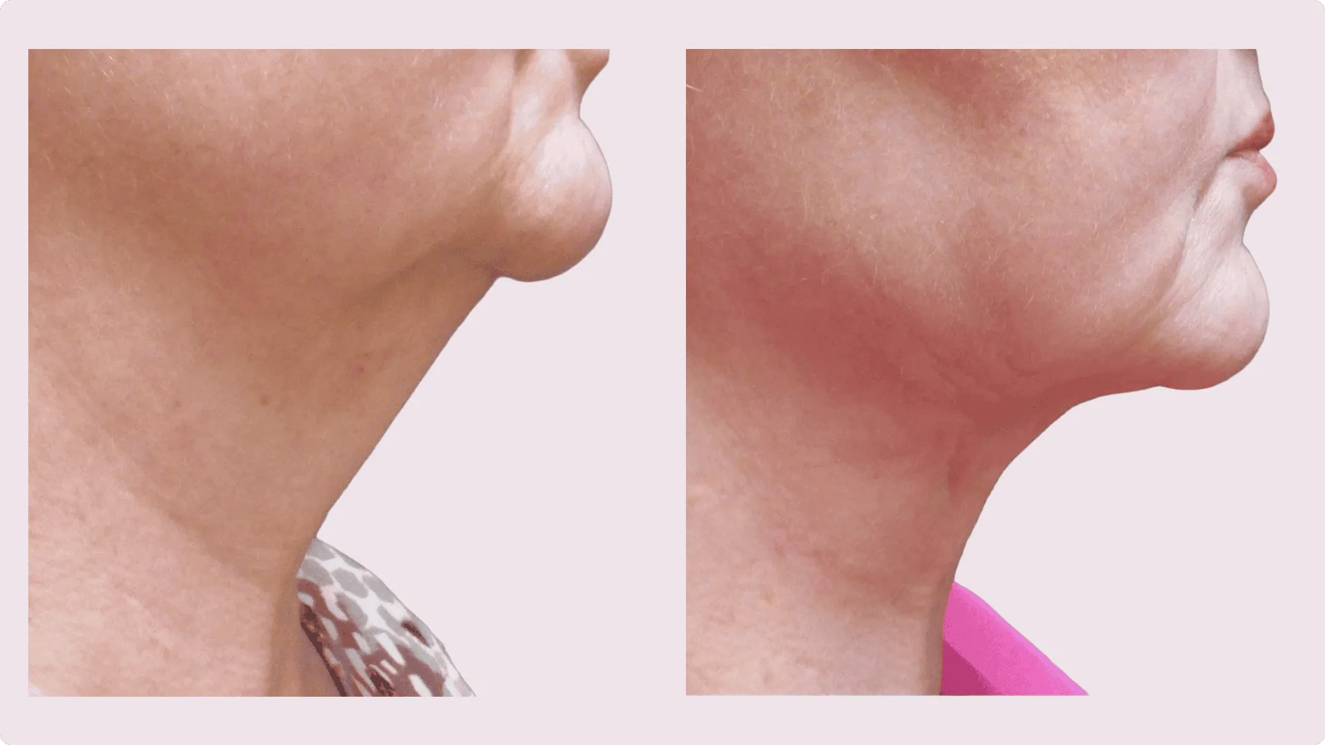Chin Liposuction – before and after photo 6