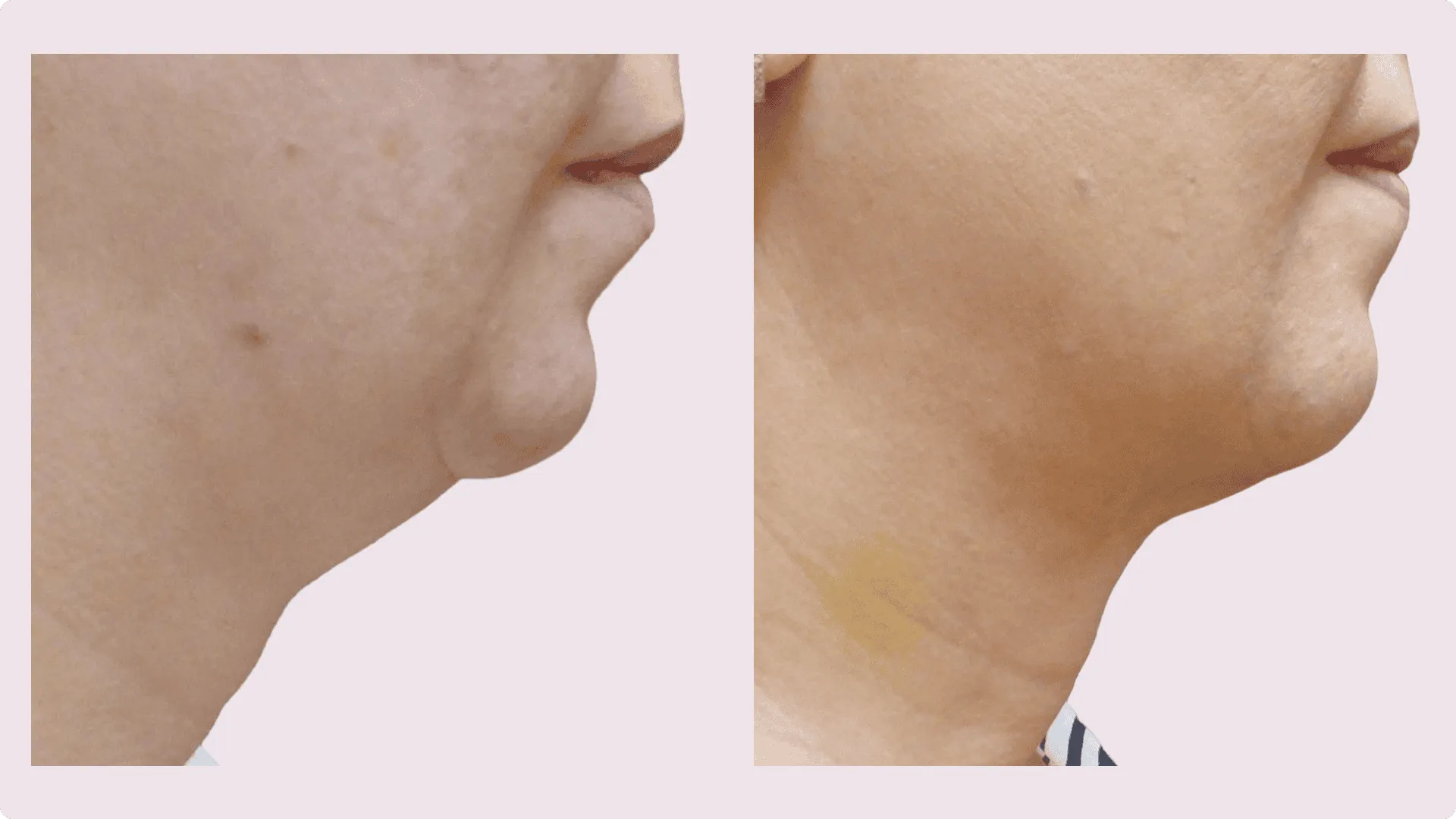 Chin Liposuction – before and after photo 8
