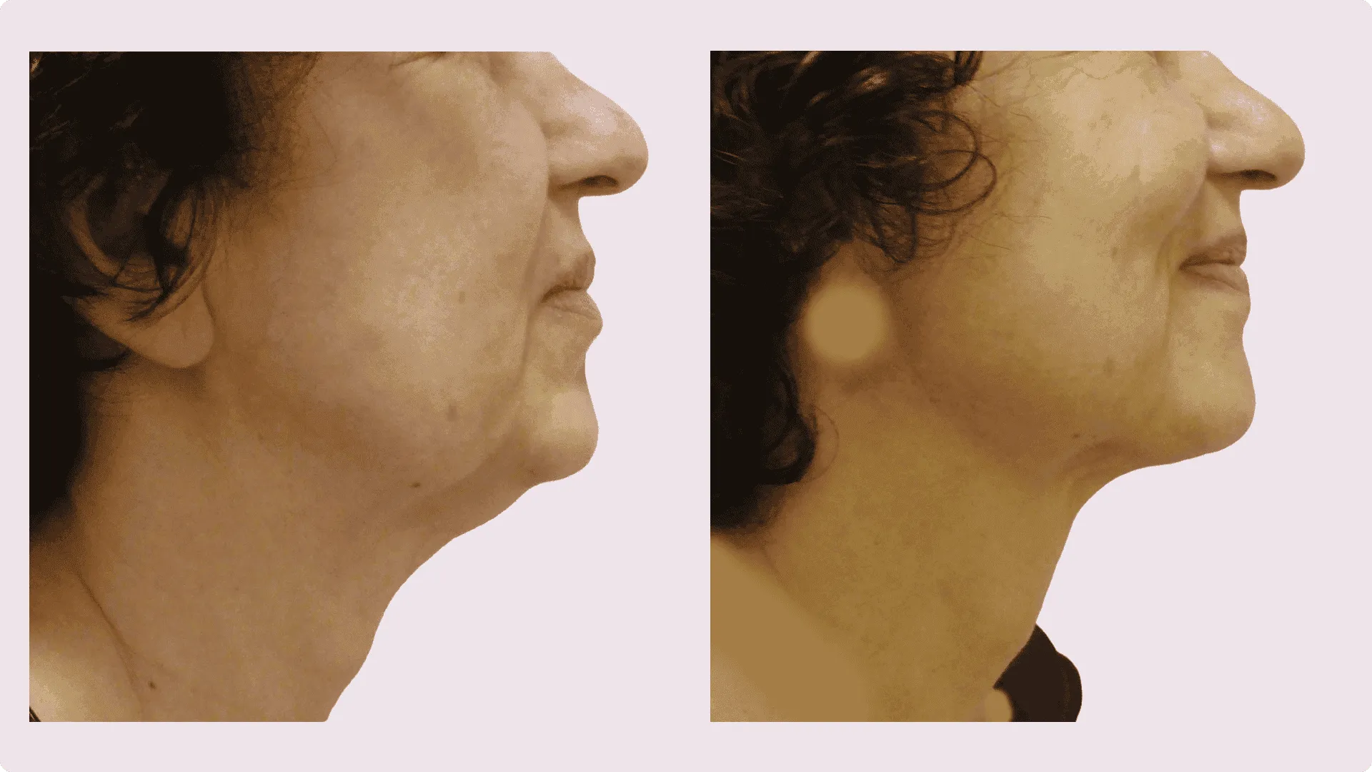 Chin Liposuction – before and after photo 9