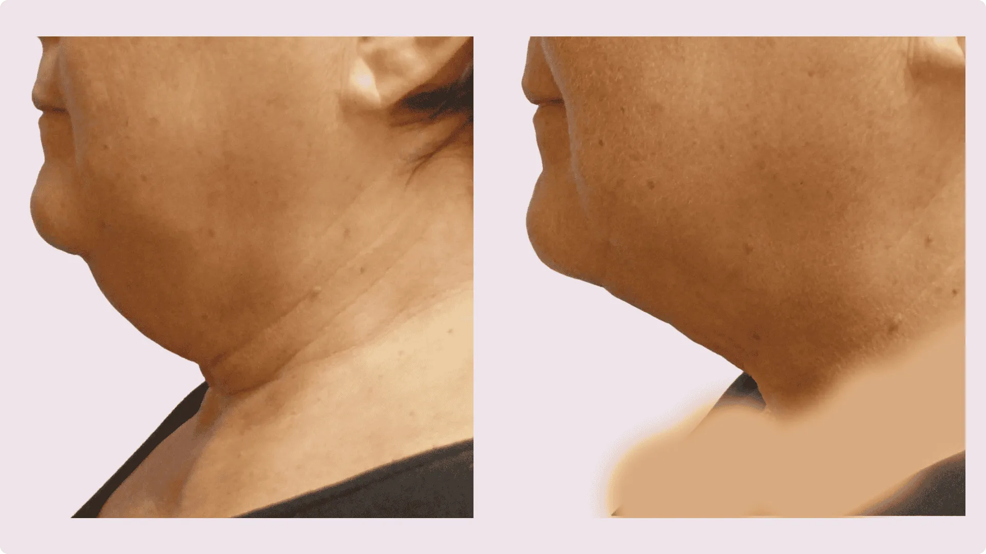 Chin Liposuction – before and after photo 11