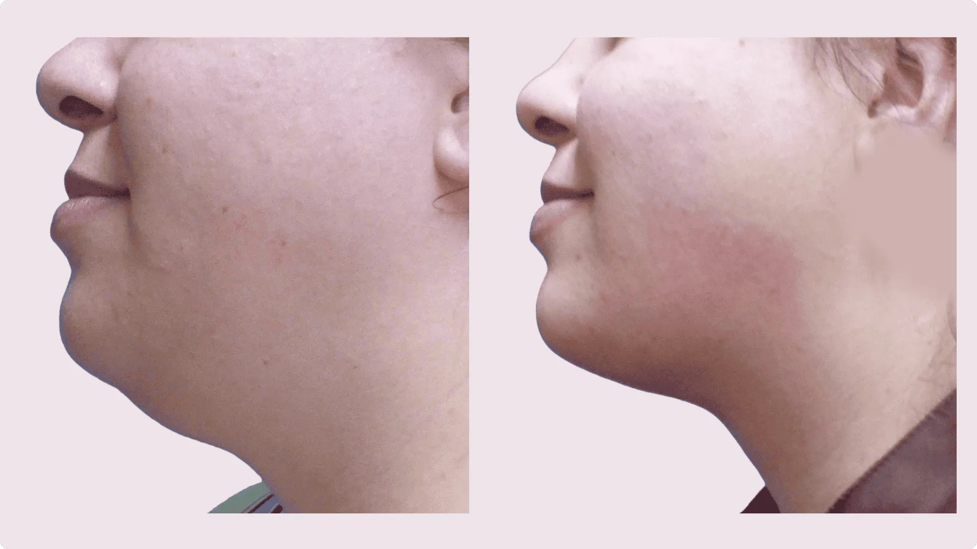 Chin Liposuction – before and after photo 12