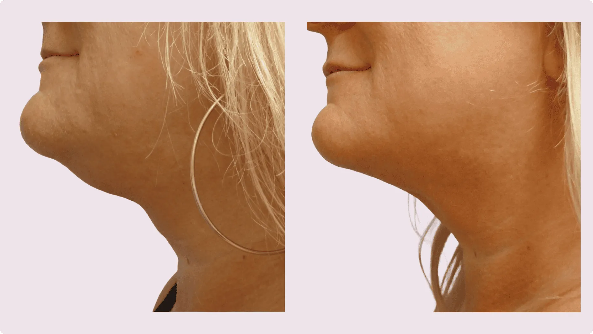Chin Liposuction – before and after photo 14
