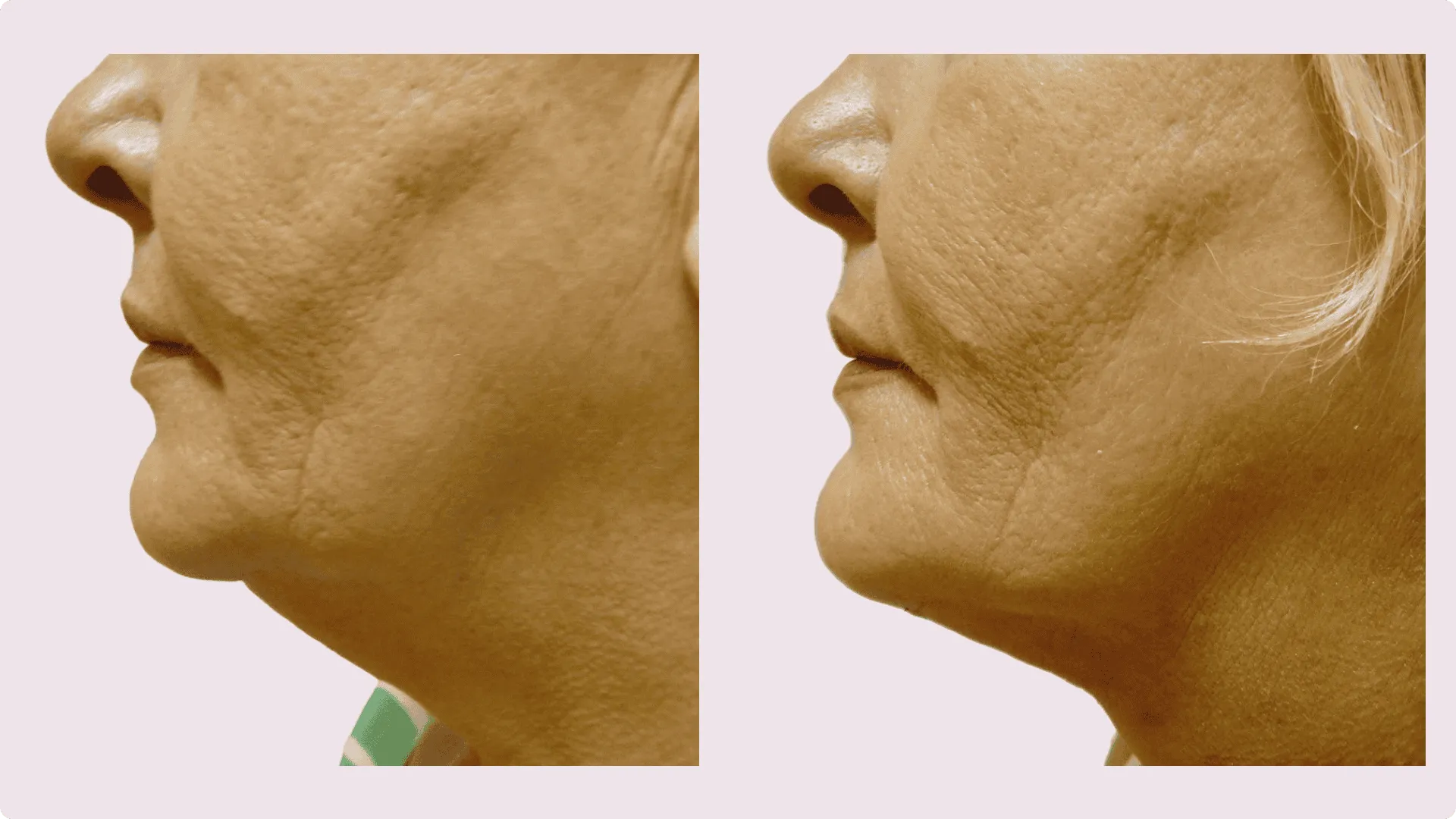 Chin Liposuction – before and after photo 15