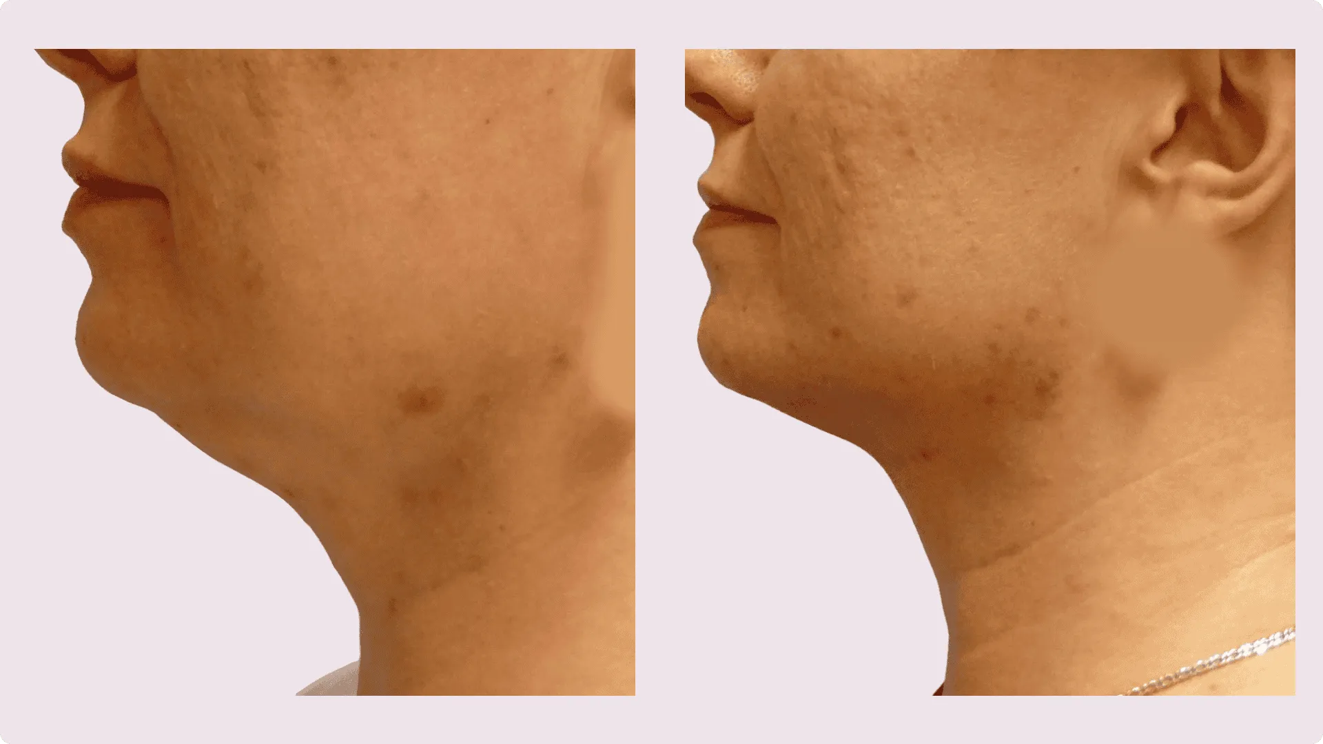 Chin Liposuction – before and after photo 16