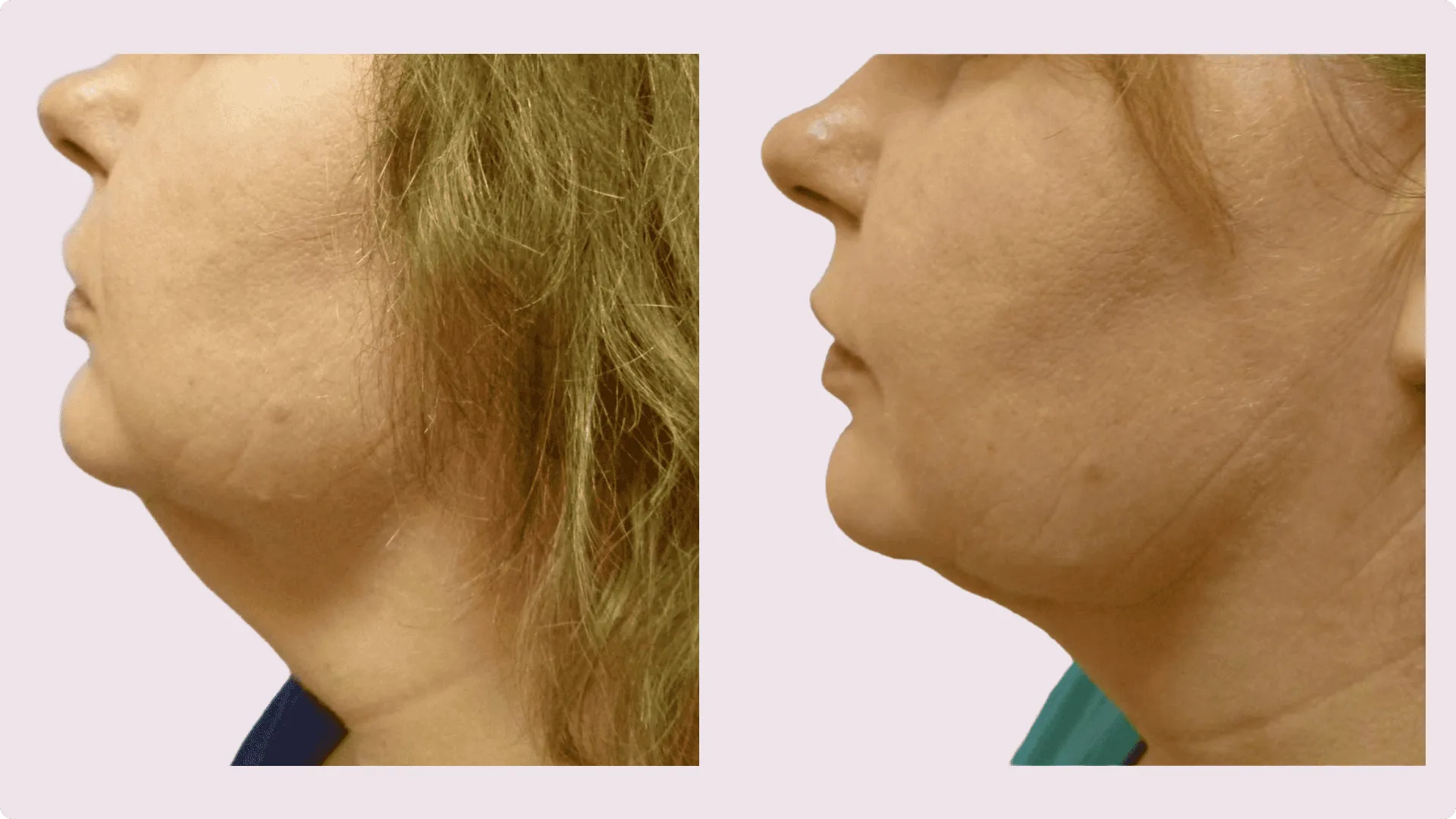 Chin Liposuction – before and after photo 17