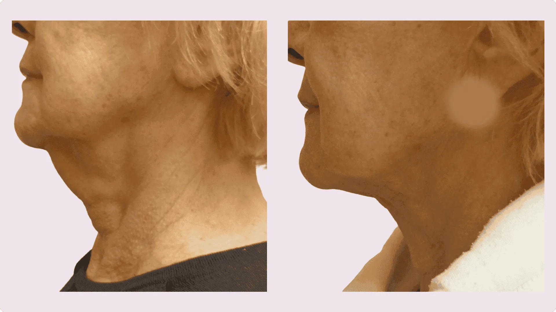 Chin Liposuction – before and after photo 18