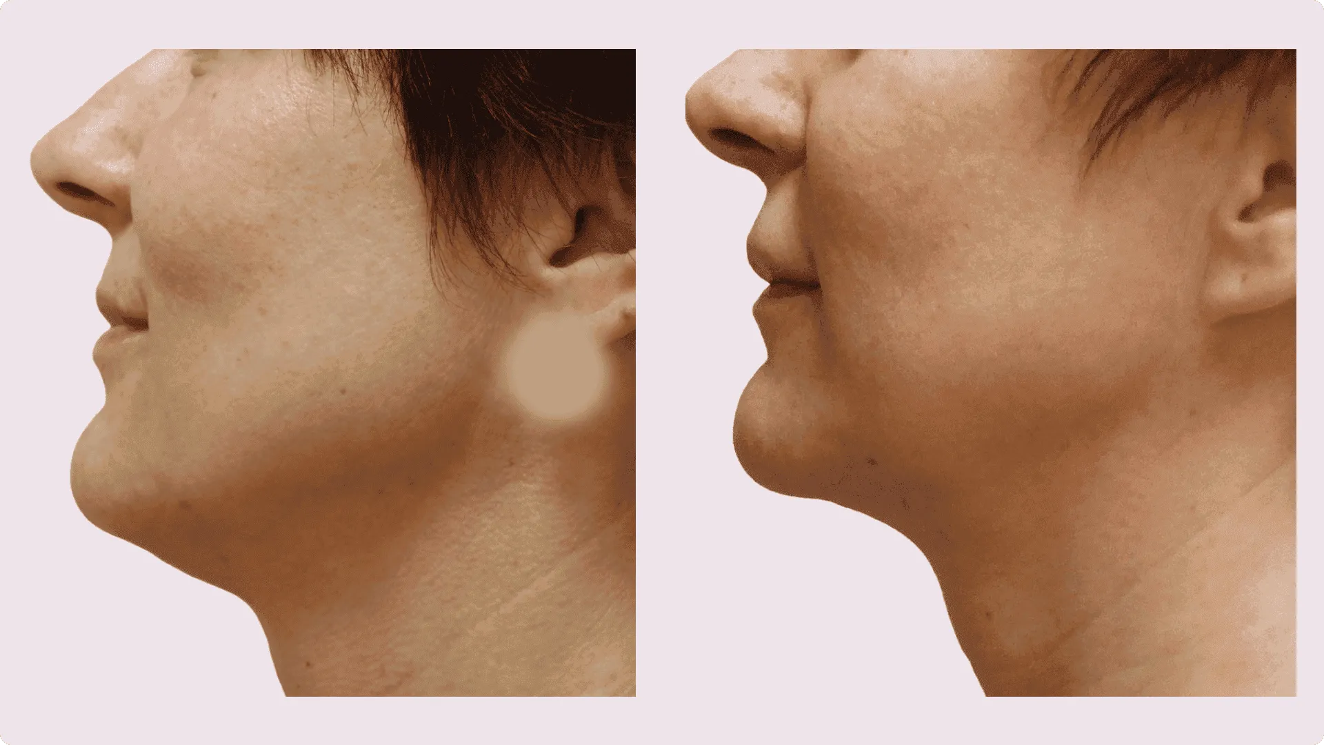 Chin Liposuction – before and after photo 19