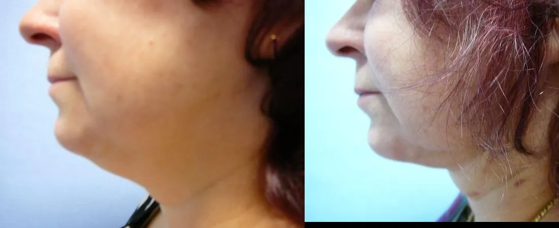 Ліпосакція підборіддя – результат 1