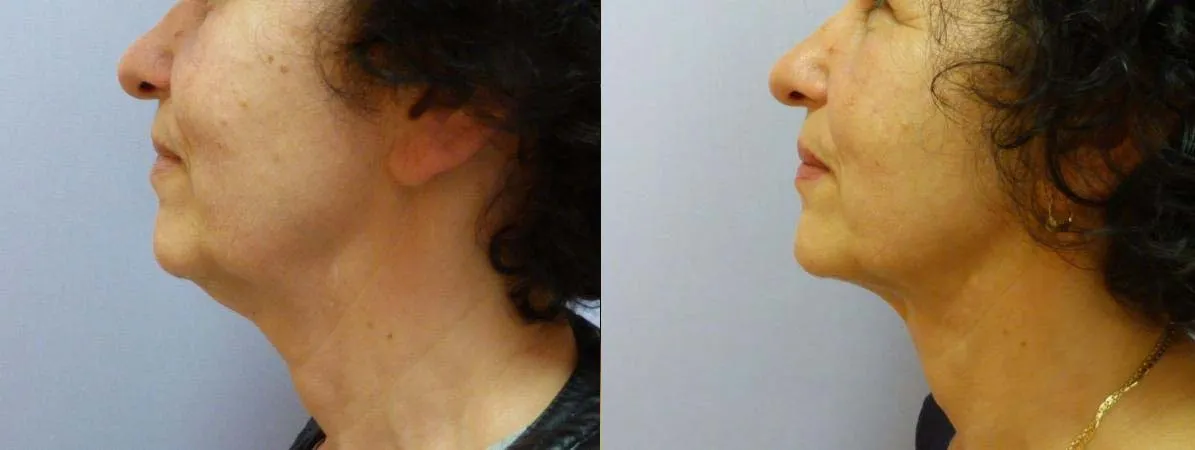 Ліпосакція підборіддя – результат 2