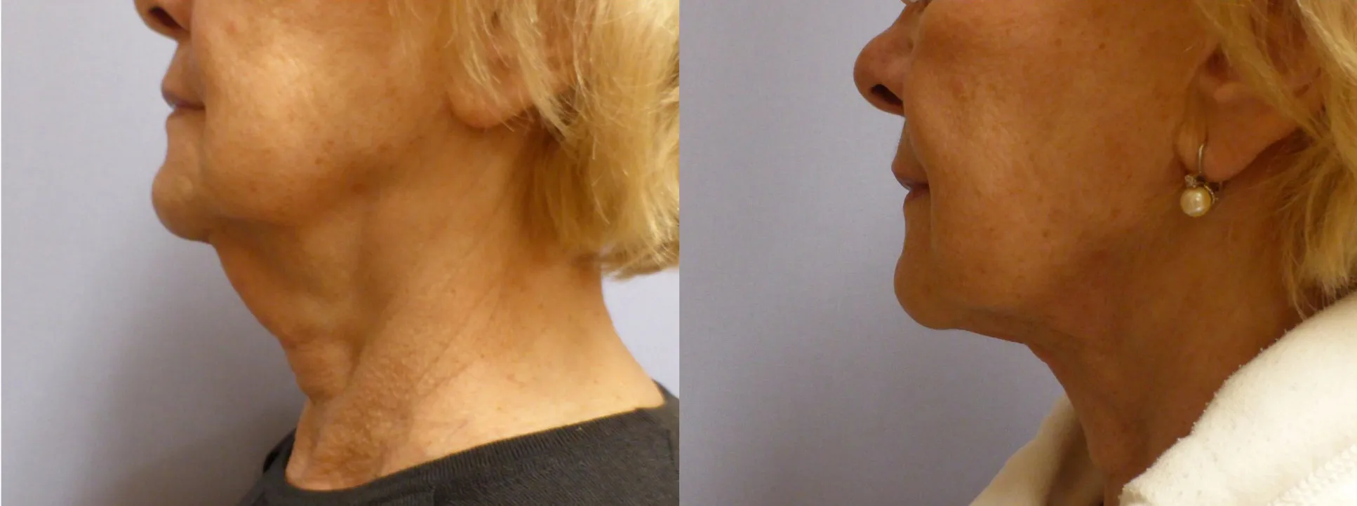 Ліпосакція підборіддя – результат 3