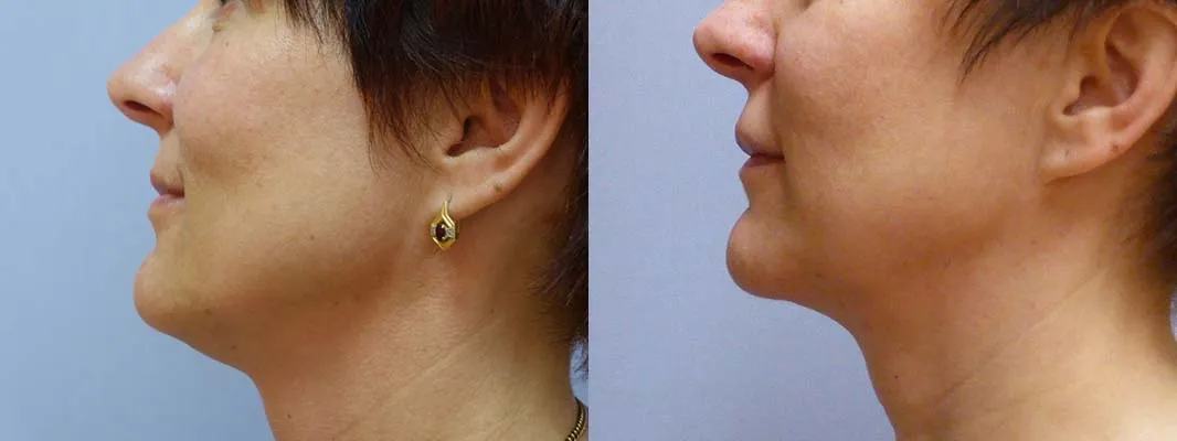 Ліпосакція підборіддя – результат 4