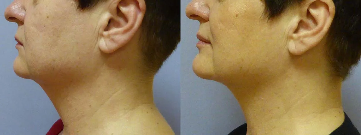 Ліпосакція підборіддя – результат 5