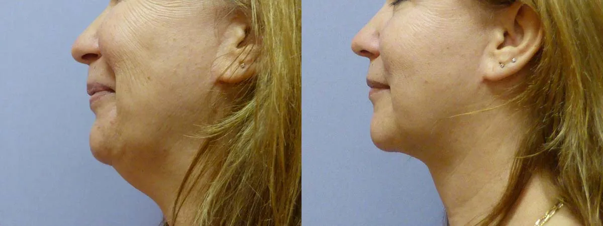 Ліпосакція підборіддя – результат 5
