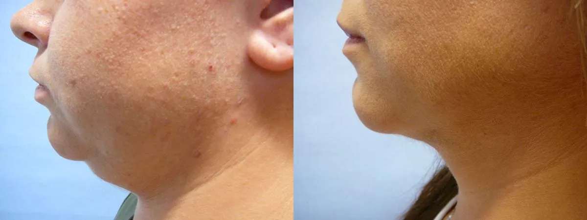 Ліпосакція підборіддя – результат 7