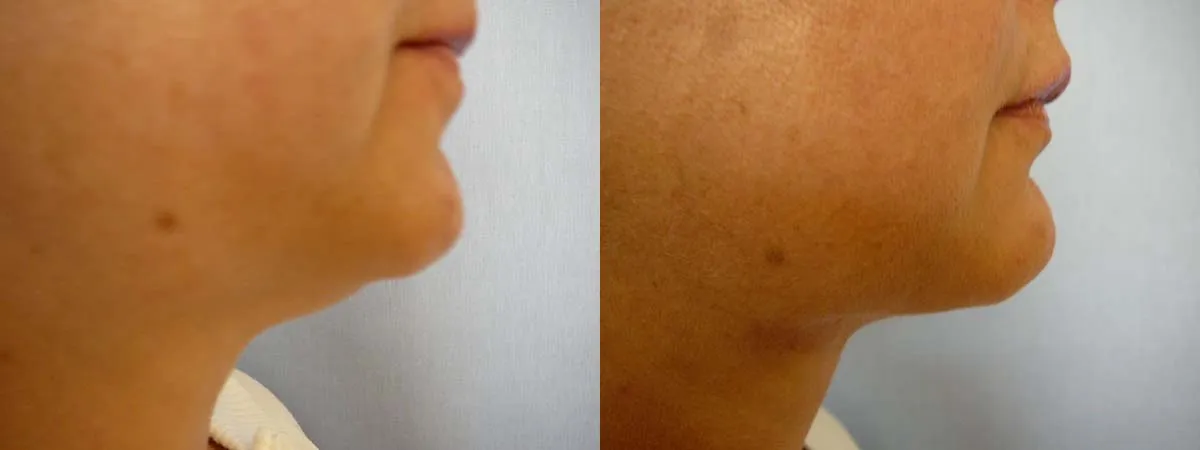 Ліпосакція підборіддя – результат 6