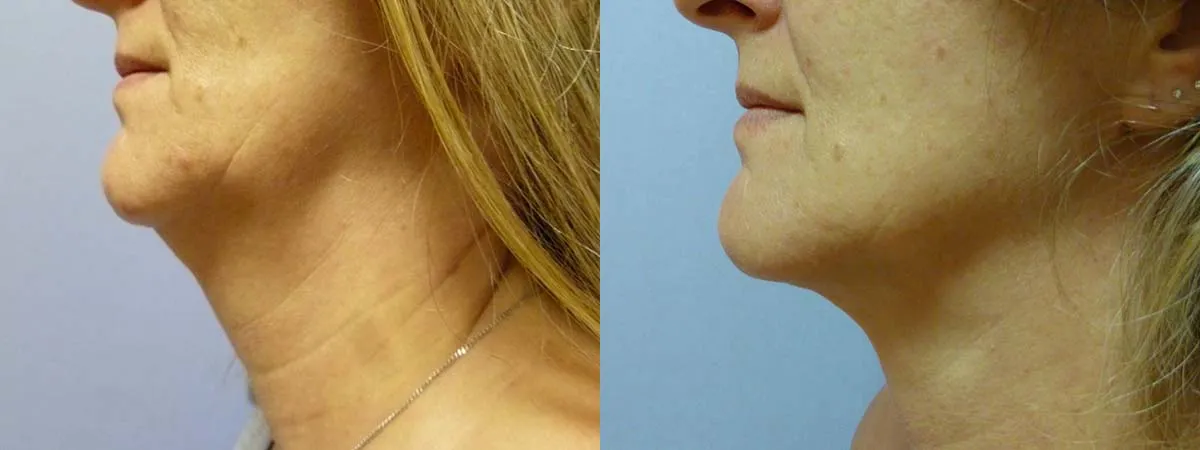 Ліпосакція підборіддя – результат 9