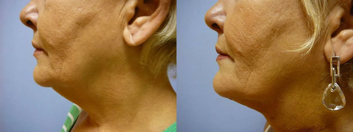 Ліпосакція підборіддя – результат 10