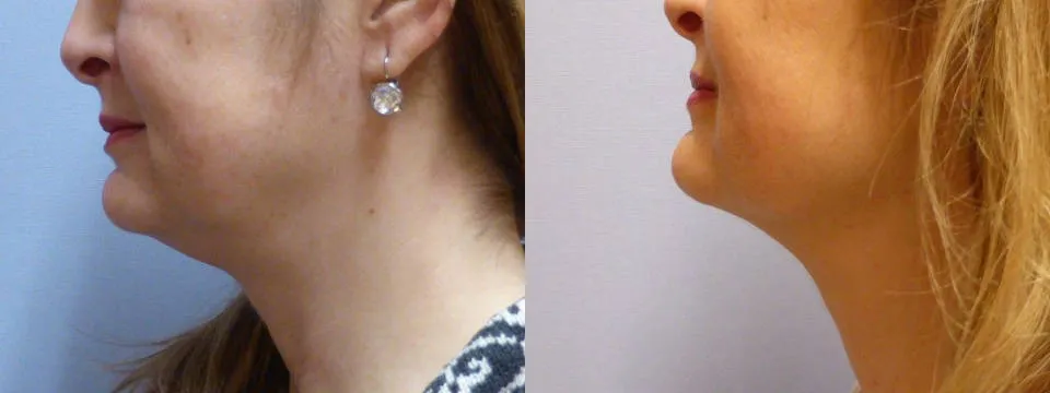 Ліпосакція підборіддя – результат 11