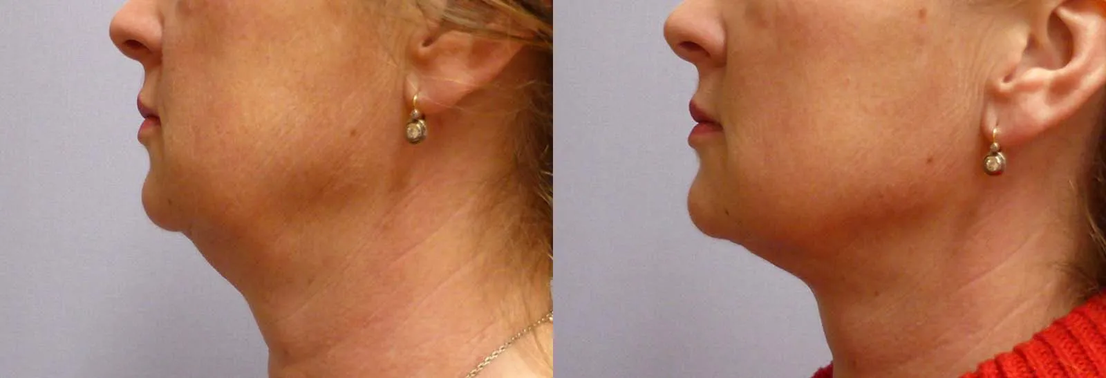 Ліпосакція підборіддя – результат 12