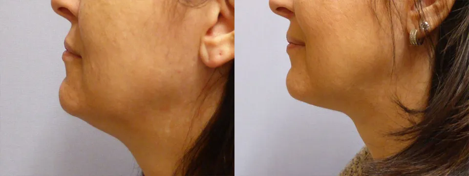 Ліпосакція підборіддя – результат 13