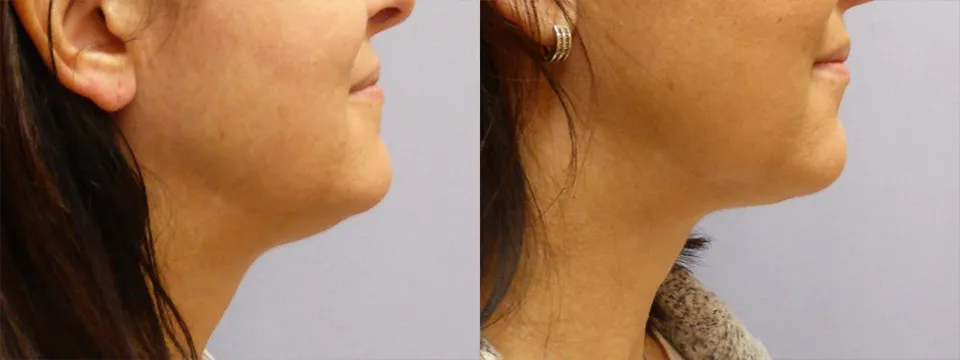 Ліпосакція підборіддя – результат 14