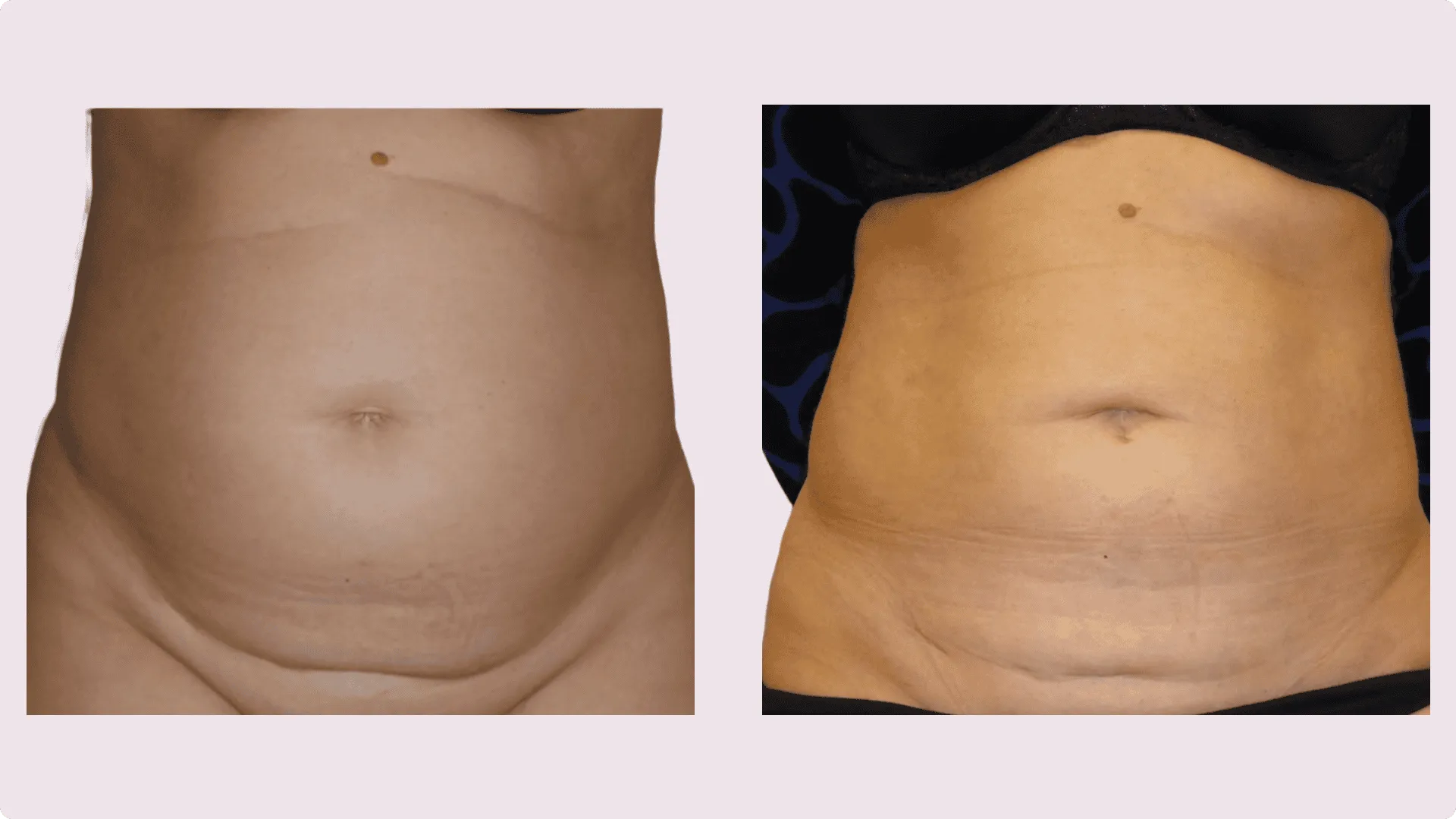 Liposuktion – Vorher-Nachher-Foto 4