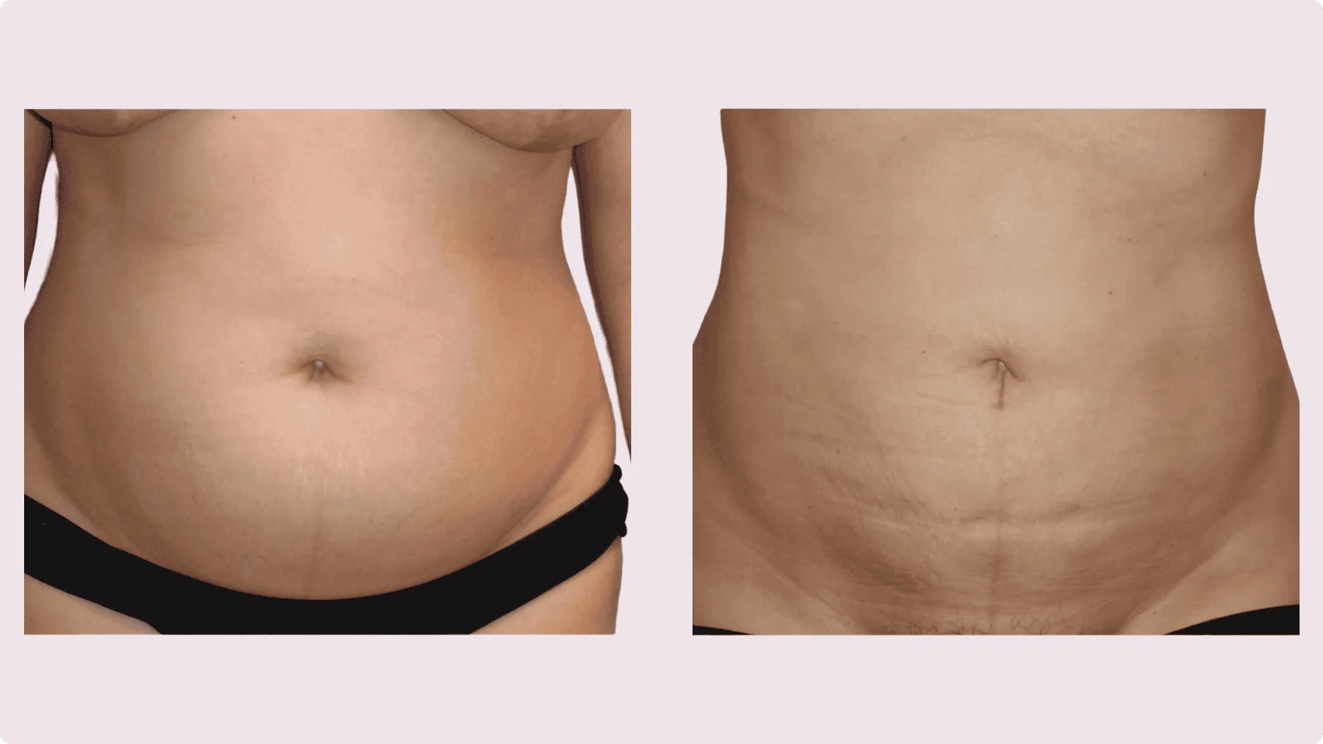 Liposuktion – Vorher-Nachher-Foto 5