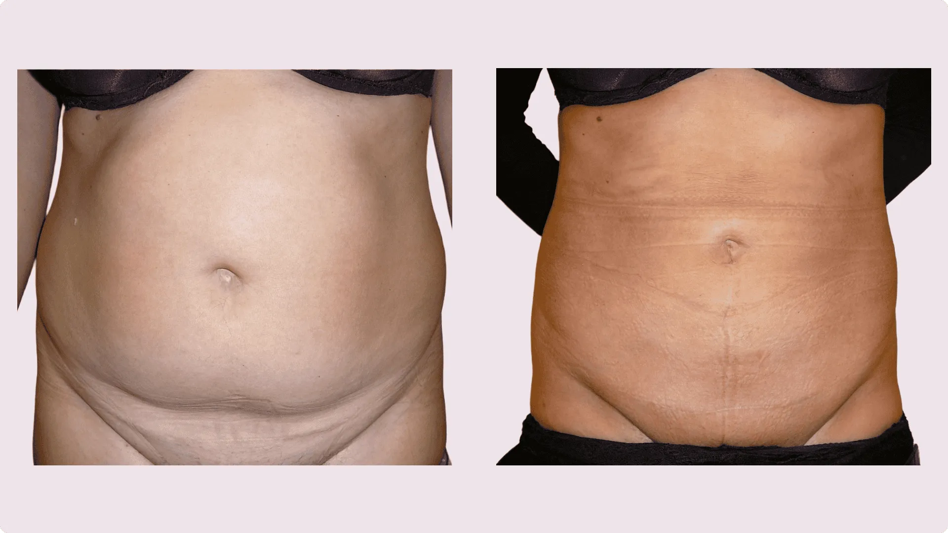 Liposuktion – Vorher-Nachher-Foto 6