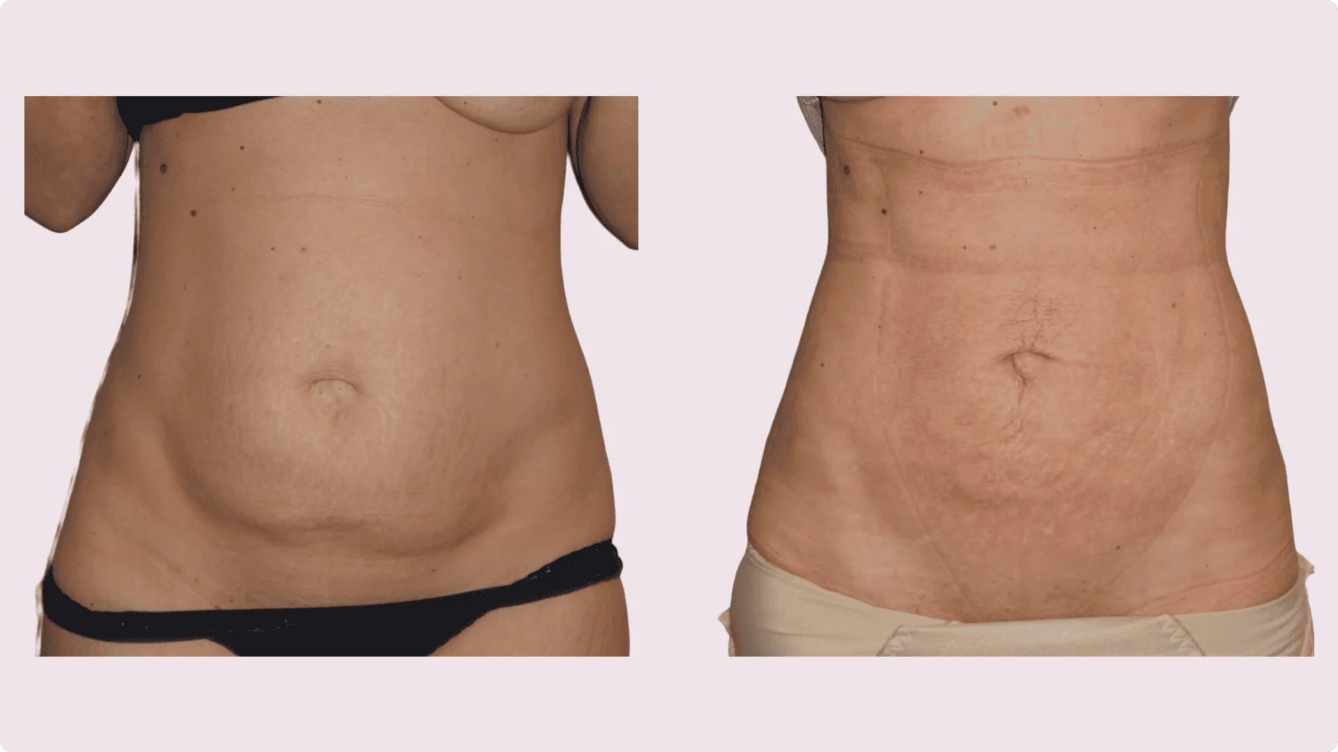 Liposuktion – Vorher-Nachher-Foto 7