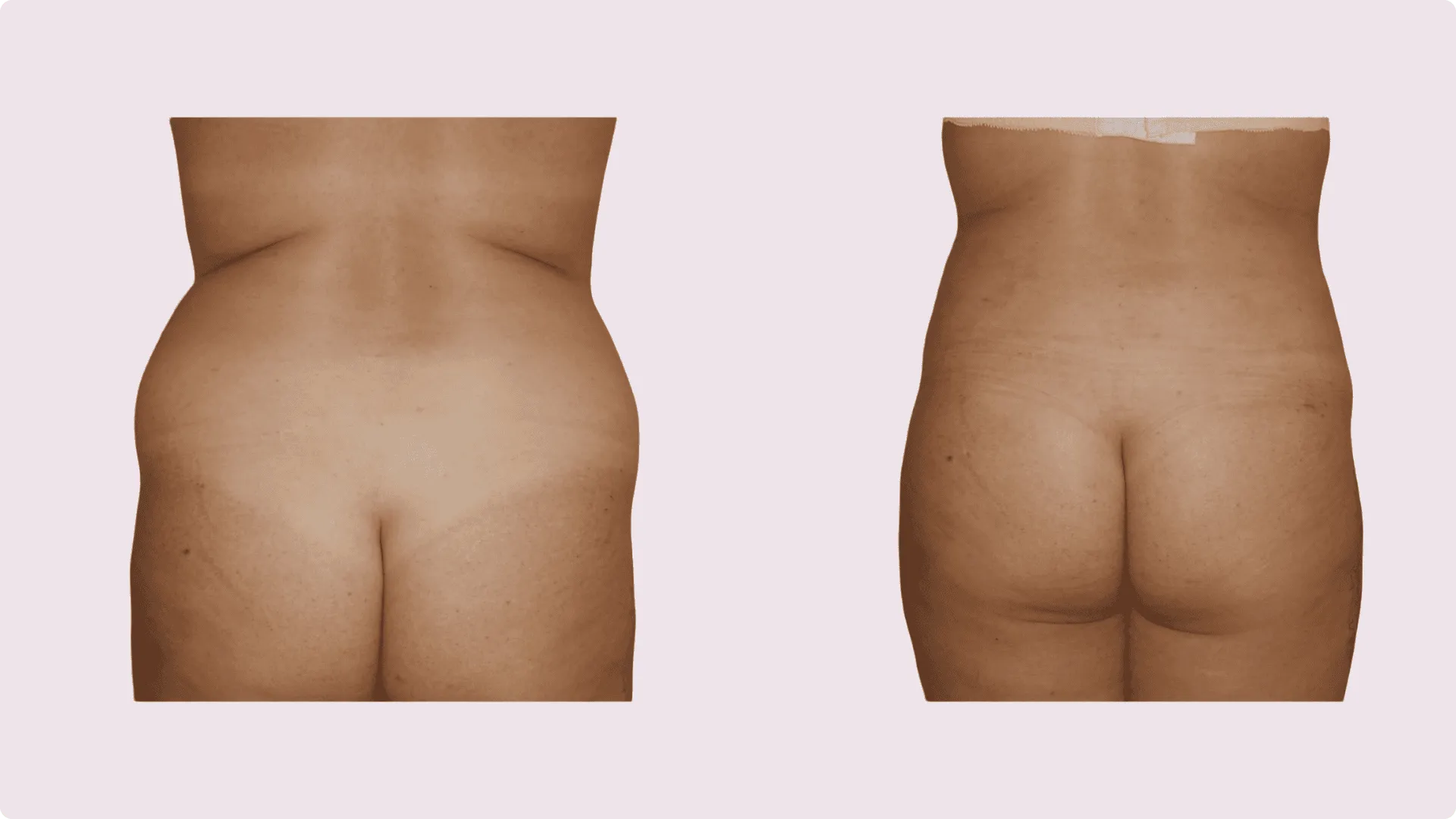 Liposuction – before and after photo 5