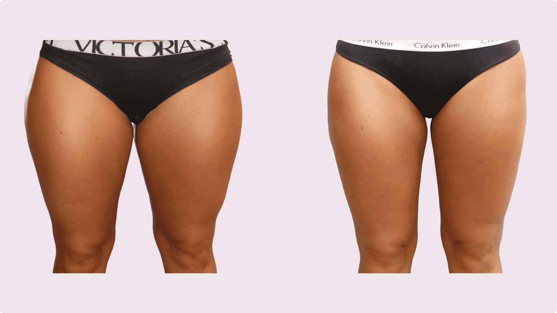 Liposuction – before and after photo 6