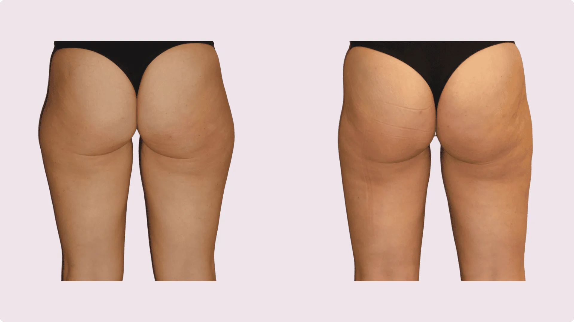 Liposuction – before and after photo 8
