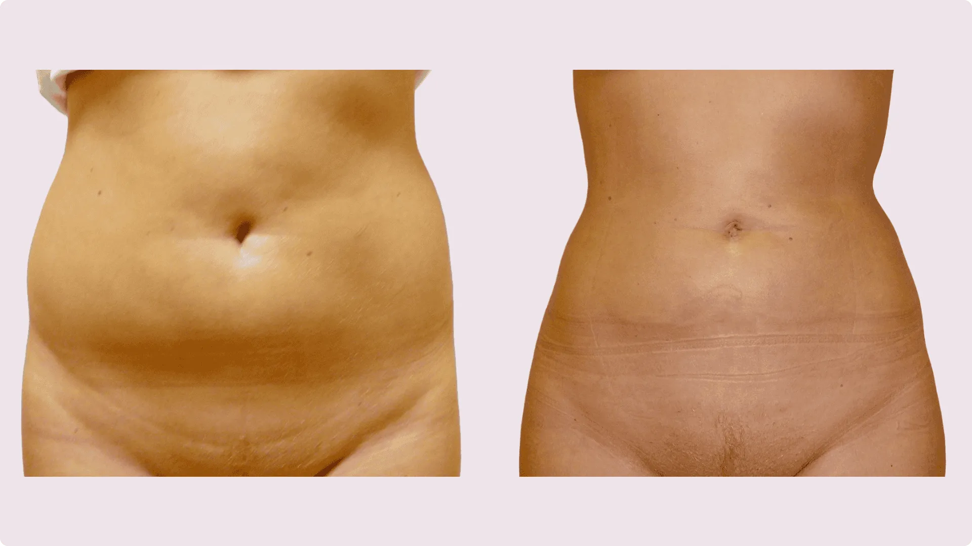 Liposuction – before and after photo 9