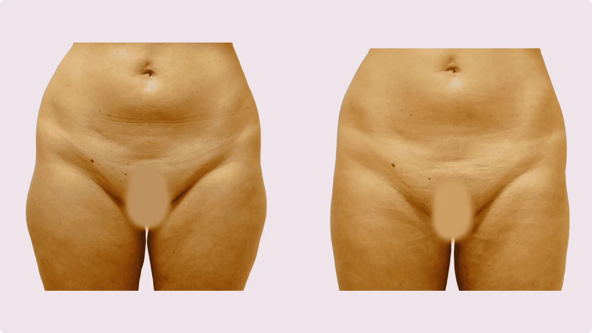 Liposuction – before and after photo 11