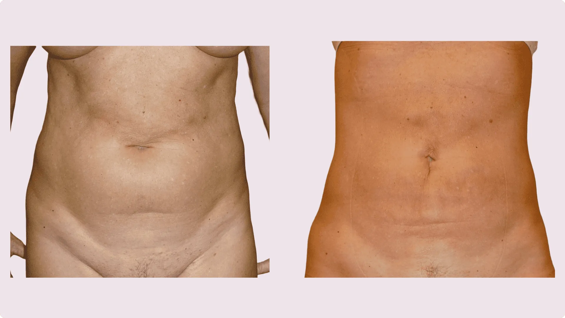 Liposuction – before and after photo 12