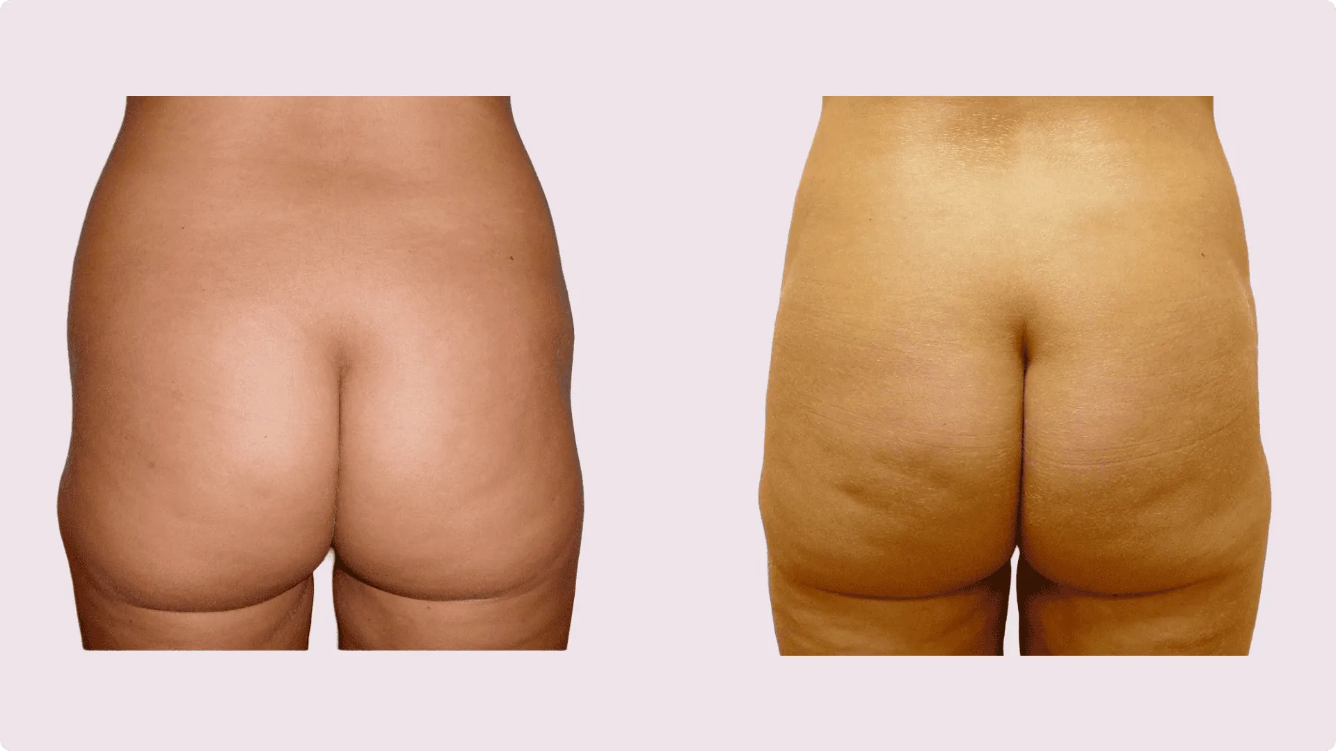 Liposuction – before and after photo 14