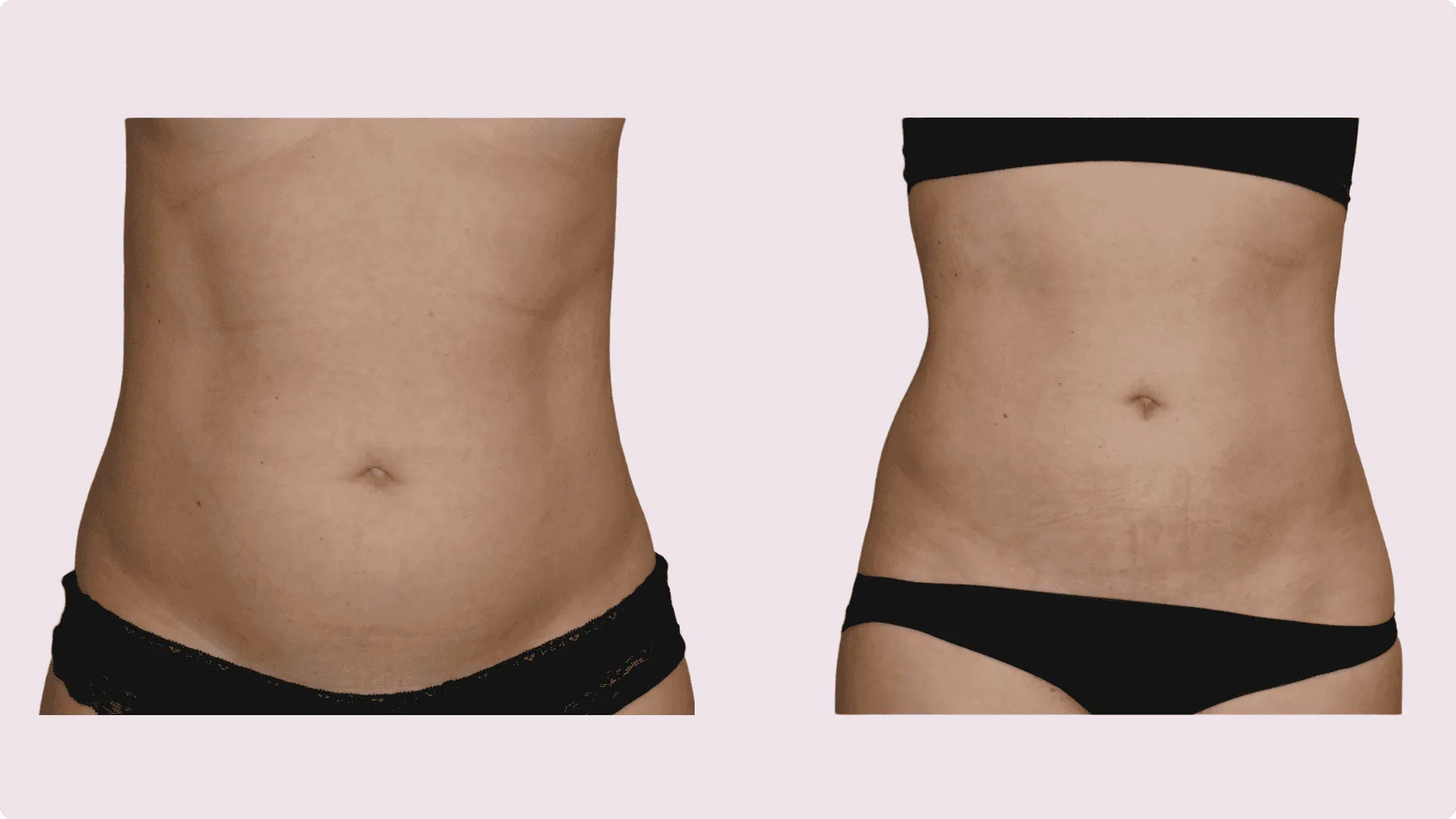 Liposuction – before and after photo 15