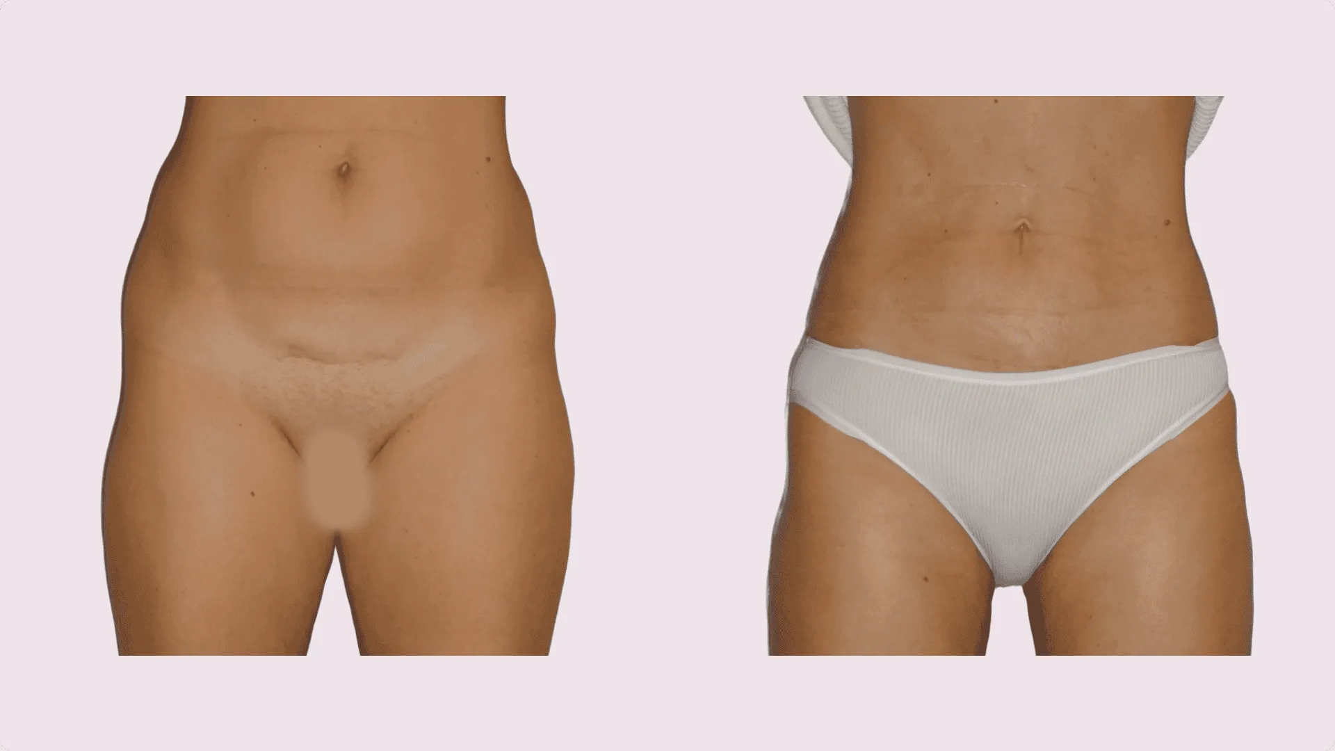 Liposuction – before and after photo 16