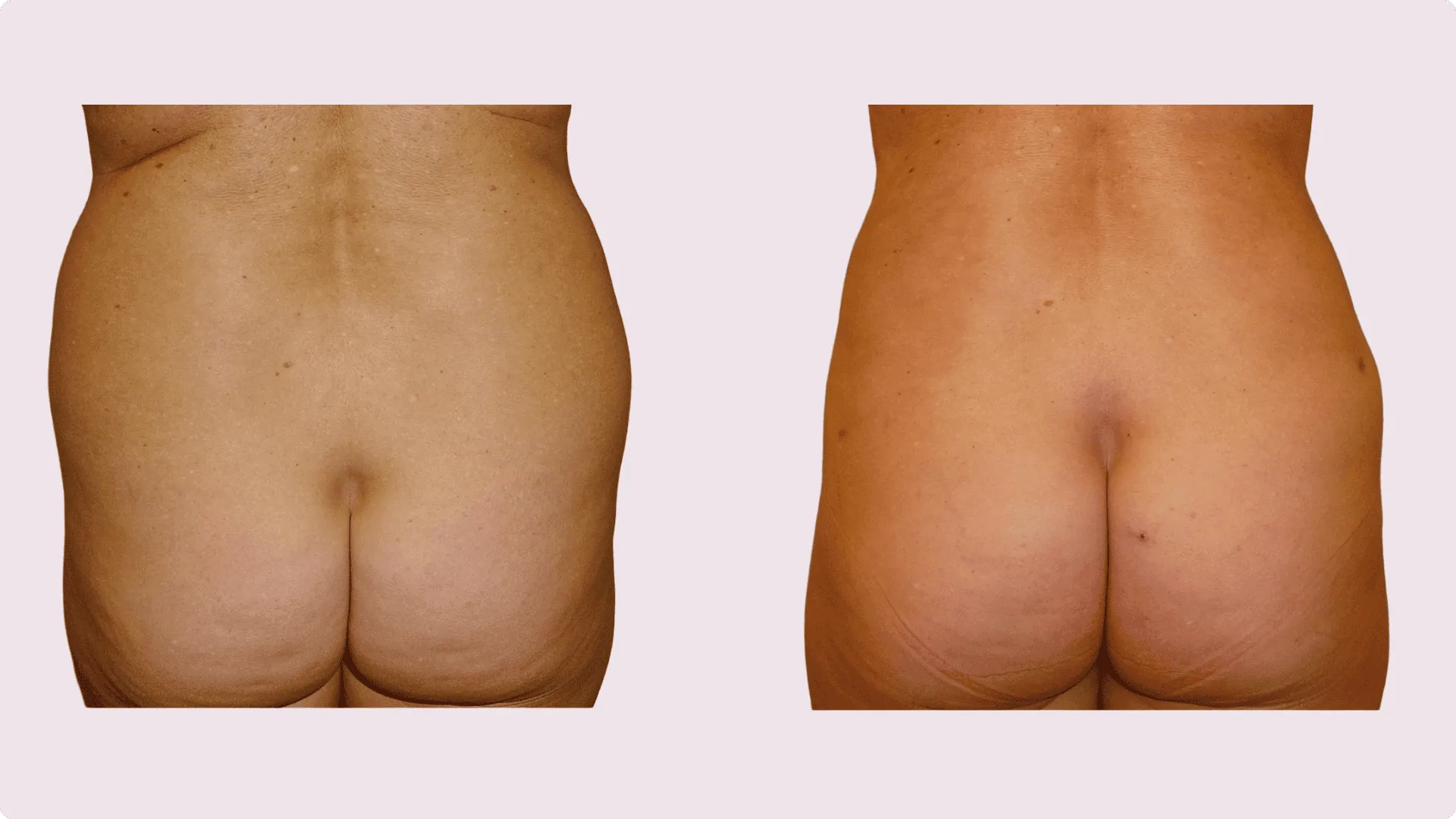 Liposuction – before and after photo 17