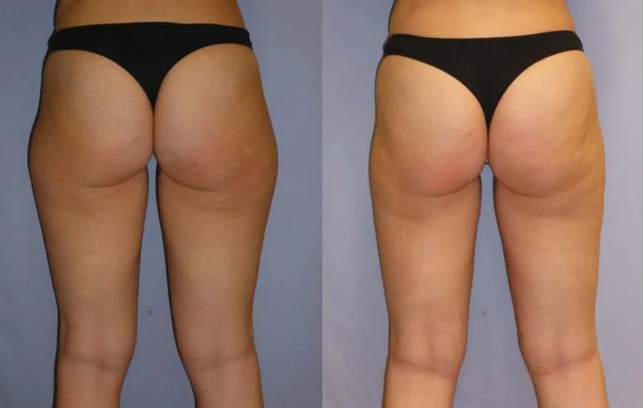 Ліпосакція – результат 1