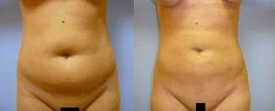 Ліпосакція – результат 2