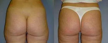 Ліпосакція – результат 3