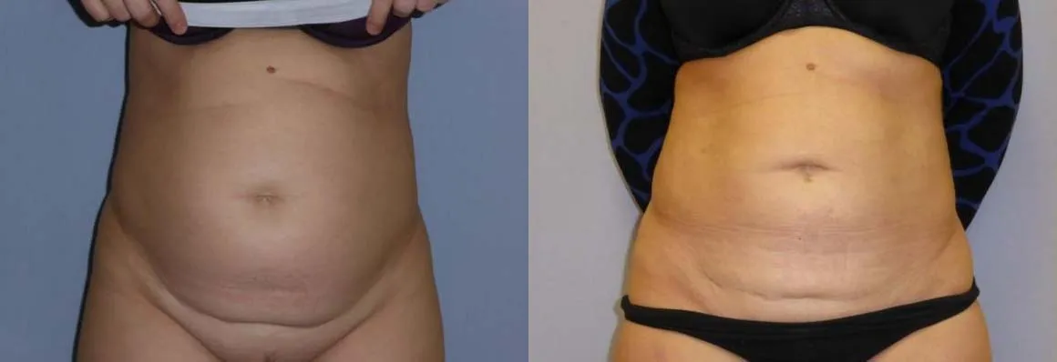Ліпосакція – результат 4
