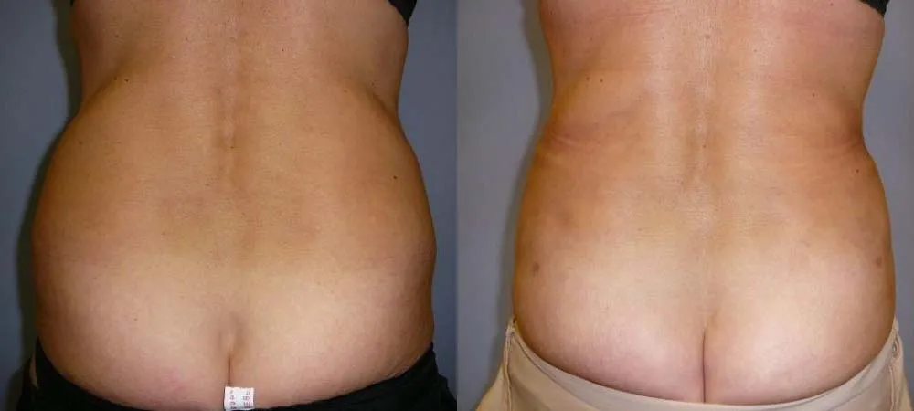 Ліпосакція – результат 5