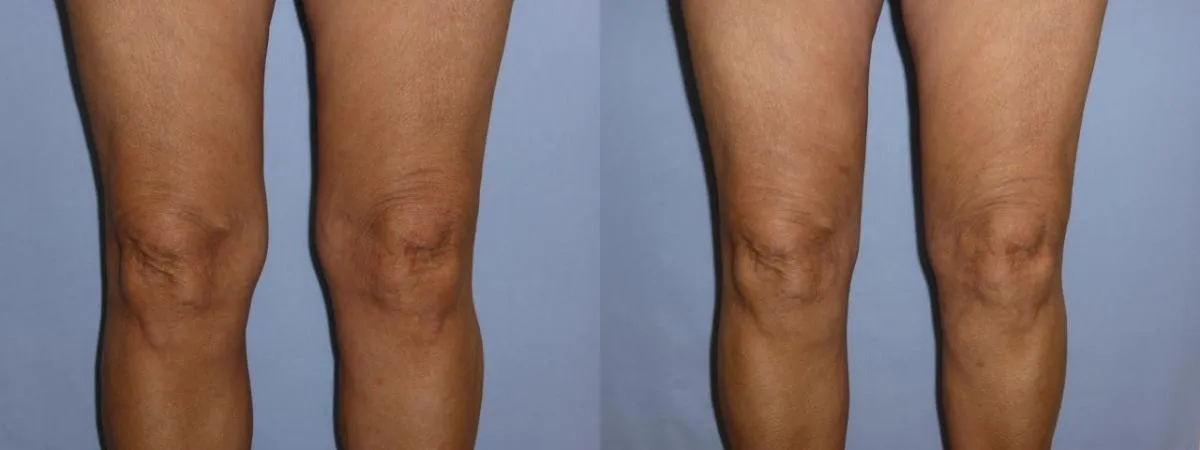 Ліпосакція – результат 5