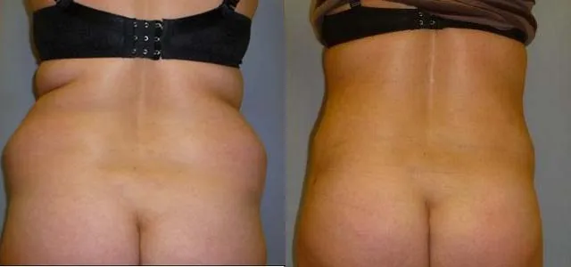 Ліпосакція – результат 7
