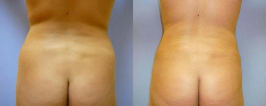 Ліпосакція – результат 6